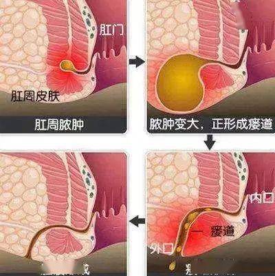 肛瘺的最新治療方法和進展探索