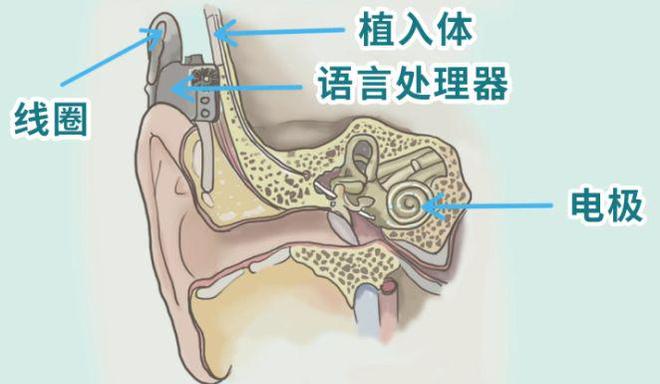 最新款人工耳蝸隱形，重塑聽障者的聽力體驗之旅